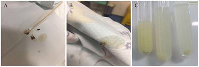 The Important Role of Endoscopy in Management of Pediatric Pseudomembranous Necrotizing Tracheitis